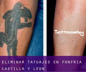 Eliminar tatuajes en Fonfría (Castilla y León)