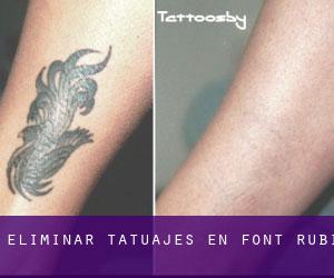 Eliminar tatuajes en Font-rubí