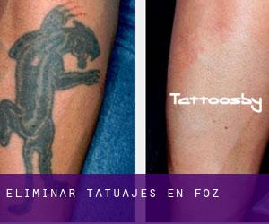Eliminar tatuajes en Foz