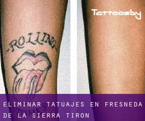 Eliminar tatuajes en Fresneda de la Sierra Tirón