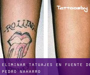 Eliminar tatuajes en Fuente de Pedro Naharro