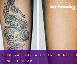 Eliminar tatuajes en Fuente el Olmo de Íscar