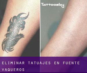 Eliminar tatuajes en Fuente Vaqueros