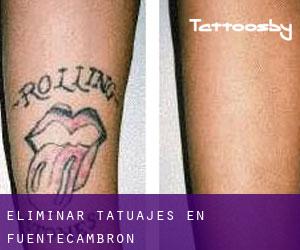 Eliminar tatuajes en Fuentecambrón