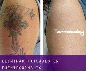 Eliminar tatuajes en Fuenteguinaldo