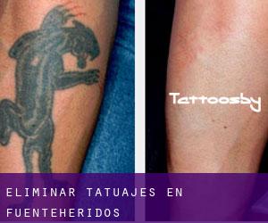 Eliminar tatuajes en Fuenteheridos