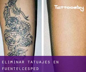 Eliminar tatuajes en Fuentelcésped