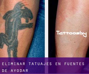 Eliminar tatuajes en Fuentes de Ayódar