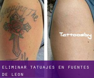 Eliminar tatuajes en Fuentes de León