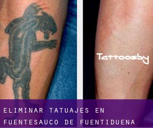 Eliminar tatuajes en Fuentesaúco de Fuentidueña