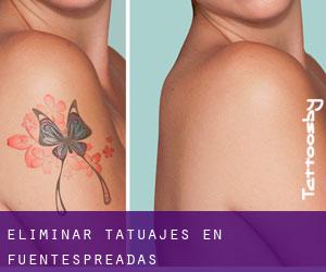 Eliminar tatuajes en Fuentespreadas