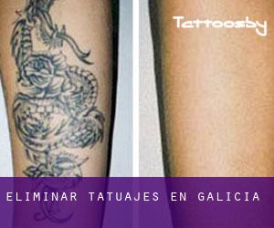 Eliminar tatuajes en Galicia