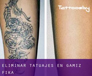 Eliminar tatuajes en Gamiz-Fika