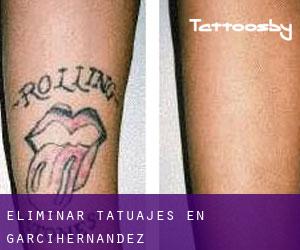 Eliminar tatuajes en Garcihernández
