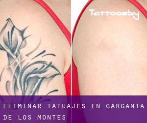 Eliminar tatuajes en Garganta de los Montes