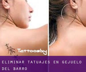 Eliminar tatuajes en Gejuelo del Barro