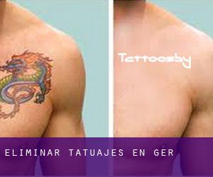 Eliminar tatuajes en Ger
