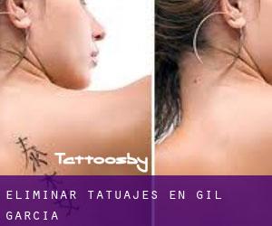 Eliminar tatuajes en Gil García