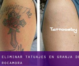 Eliminar tatuajes en Granja de Rocamora