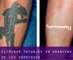 Eliminar tatuajes en Granyena de les Garrigues