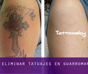 Eliminar tatuajes en Guarromán