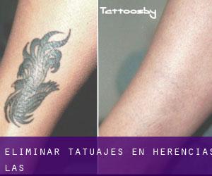 Eliminar tatuajes en Herencias (Las)