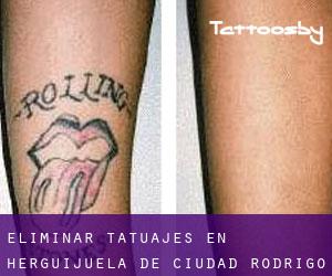 Eliminar tatuajes en Herguijuela de Ciudad Rodrigo