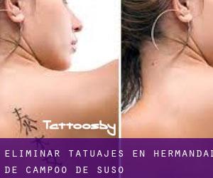 Eliminar tatuajes en Hermandad de Campoo de Suso