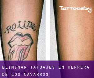 Eliminar tatuajes en Herrera de los Navarros