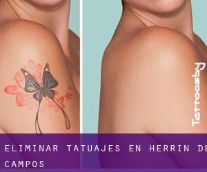 Eliminar tatuajes en Herrín de Campos