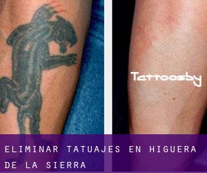 Eliminar tatuajes en Higuera de la Sierra