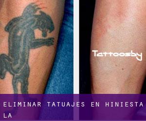 Eliminar tatuajes en Hiniesta (La)