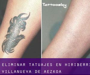 Eliminar tatuajes en Hiriberri / Villanueva de Aezkoa