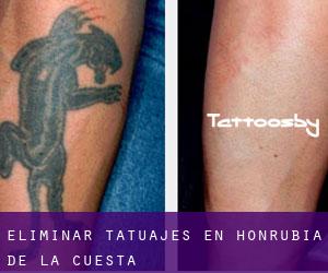 Eliminar tatuajes en Honrubia de la Cuesta