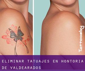 Eliminar tatuajes en Hontoria de Valdearados