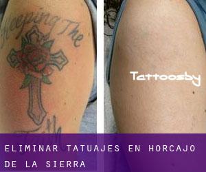 Eliminar tatuajes en Horcajo de la Sierra