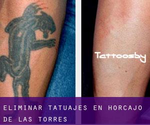 Eliminar tatuajes en Horcajo de las Torres