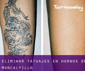 Eliminar tatuajes en Hornos de Moncalvillo