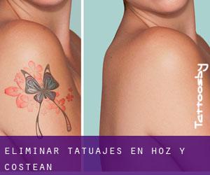 Eliminar tatuajes en Hoz y Costean