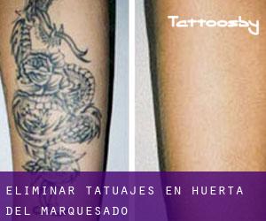 Eliminar tatuajes en Huerta del Marquesado