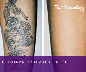 Eliminar tatuajes en Ibi
