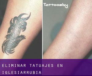 Eliminar tatuajes en Iglesiarrubia