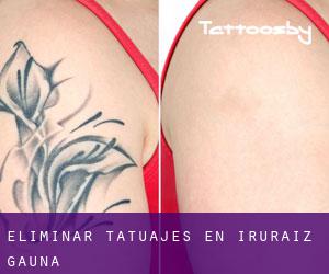 Eliminar tatuajes en Iruraiz-Gauna