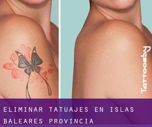 Eliminar tatuajes en Islas Baleares (Provincia)