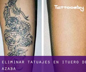 Eliminar tatuajes en Ituero de Azaba
