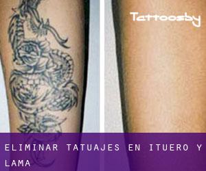 Eliminar tatuajes en Ituero y Lama