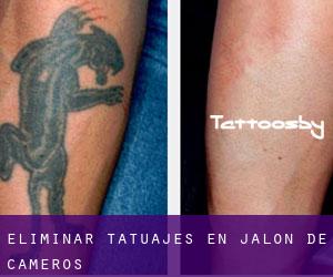 Eliminar tatuajes en Jalón de Cameros