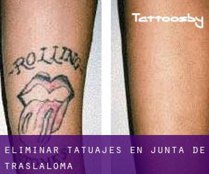 Eliminar tatuajes en Junta de Traslaloma