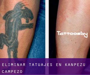 Eliminar tatuajes en Kanpezu / Campezo