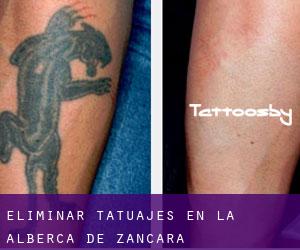 Eliminar tatuajes en La Alberca de Záncara